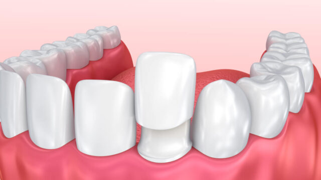 How is a Veneer Applied Without Filing Down the Teeth? | Livera Dental Clinic