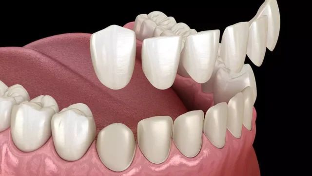 what-are-dental-veneers-made | Livera Dental Clinic