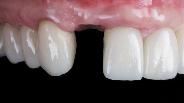 Straumann İmplantları