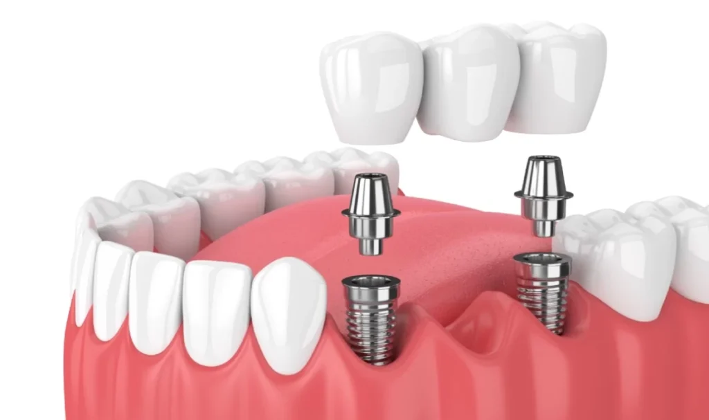 all on six implant