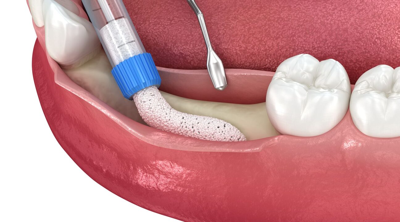 What is Alveoloplasty? How is it Performed and Post-Care? | Livera Dental Clinic