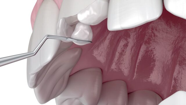 What is Composite Filling? | Livera Dental Clinic