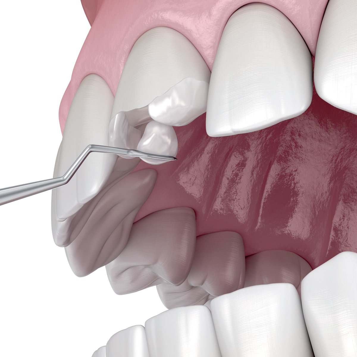 Straumann İmplantları