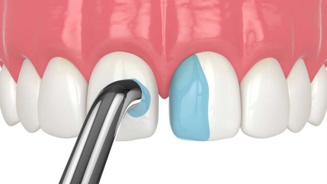 Dental Implant