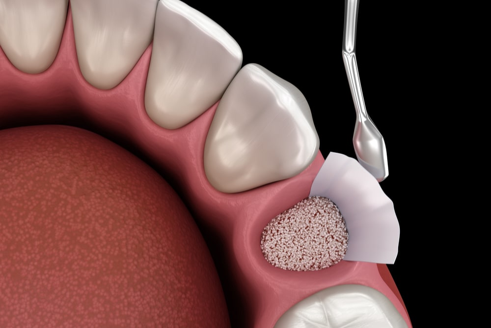 Dental Bone Grafting