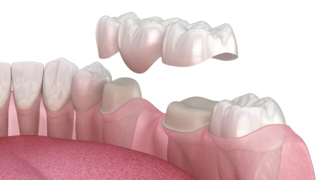 Dental Implant