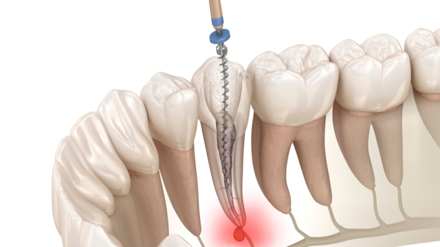 What is Dental Nerve Death, What Causes It, and How Is It Treated? | Livera Dental Clinic