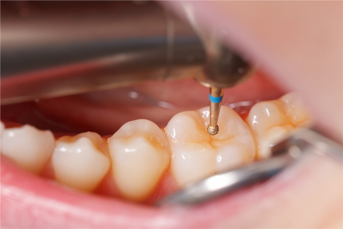 How Is the Dental Nerve Removed? | Livera Dental Clinic