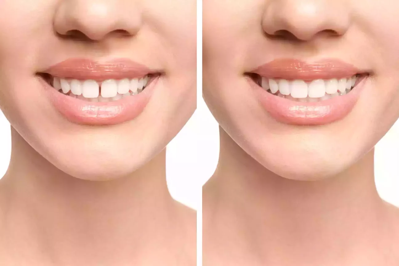 Types of Diastema, Causes, and Treatment Costs | Livera Dental Clinic