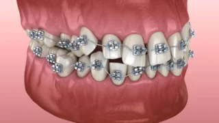 What is Orthodontics? Types, Benefits, and Treatment Options 4 deep bite