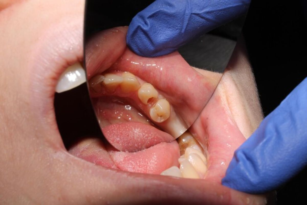 What is a Tooth Abscess and How Does it Go Away? | Livera Dental Clinic