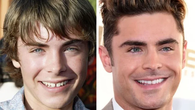 The Early Days of Zac Efron Teeth: The Iconic Gap - Before and After | Livera Dental Clinic